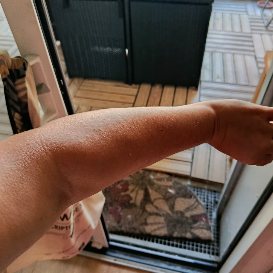 Dernière photo de mon bras vierge